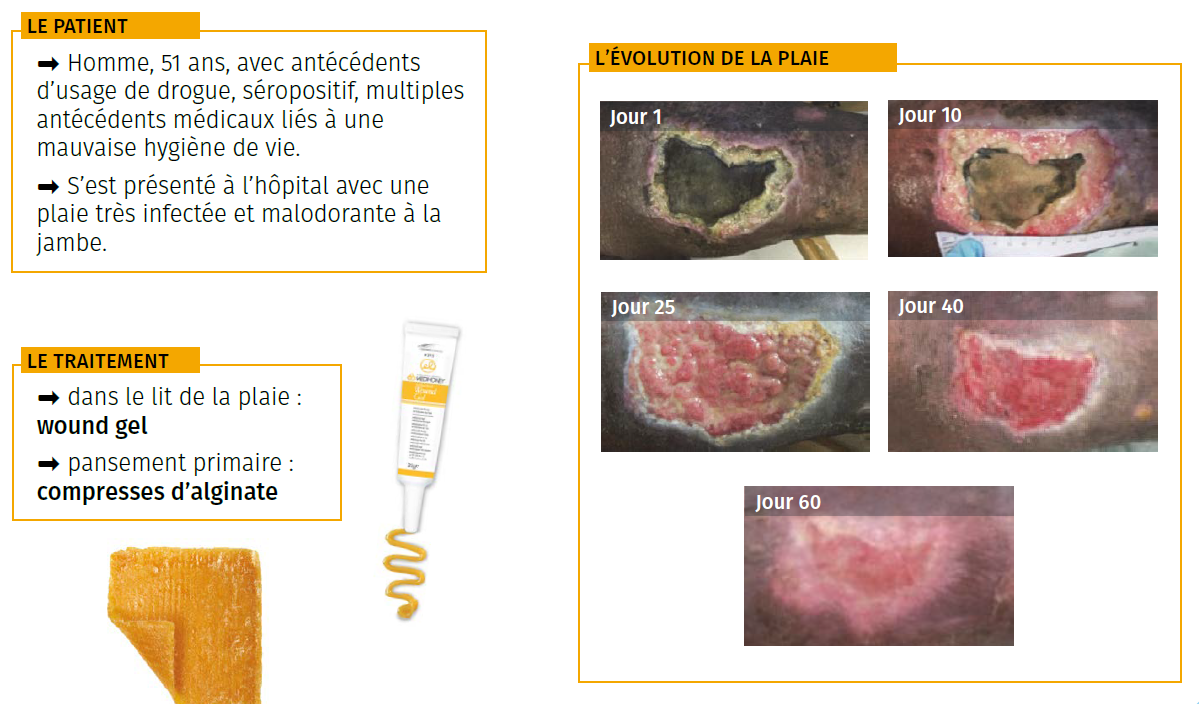 1 étude de cas ulcère nécrosé infecté