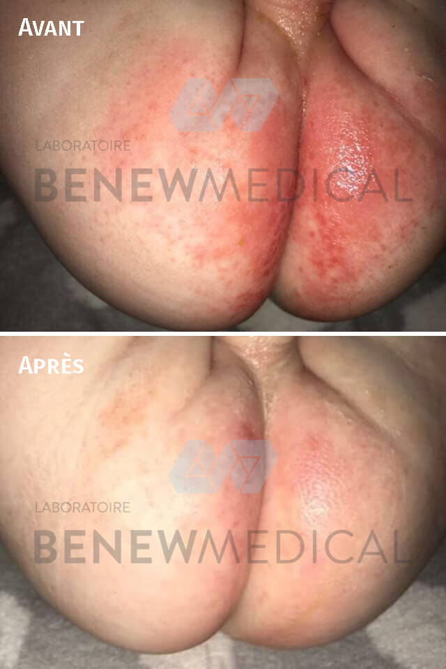 avant après érythème fessier bébé crème de protection medihoney