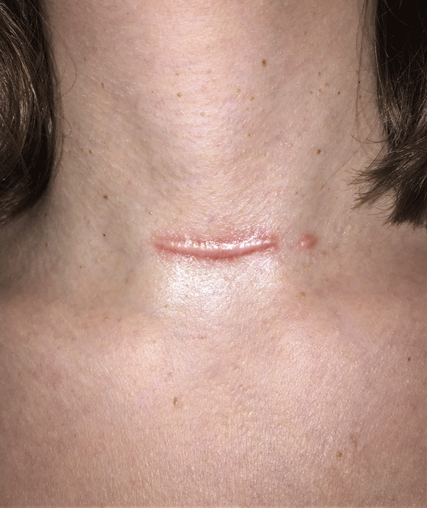 Patch de traitement de feuille de cicatrice de gel de silicone, bande  d'élimination des traumatismes d'acné, couverture de cicatrice de brûlure,  réparation de la peau, section de beauté des oreilles, 150cm 