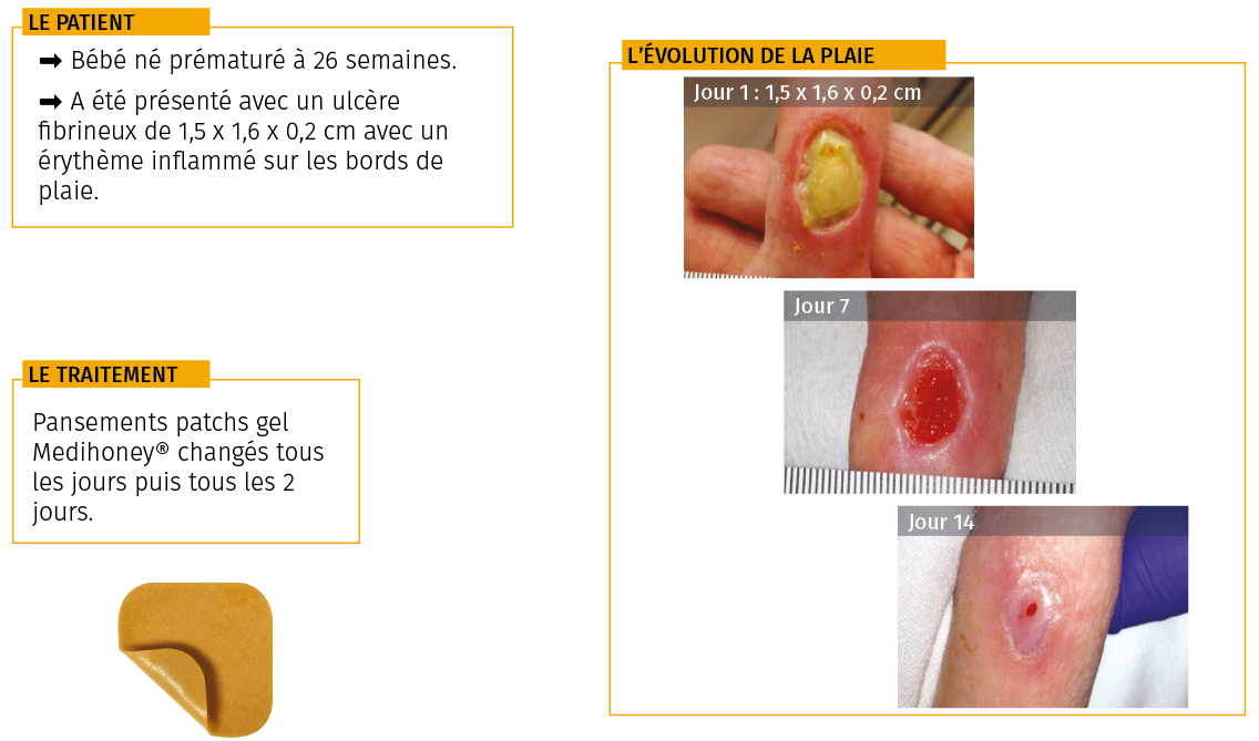 Etude de cas ulcère néonat pansement gel