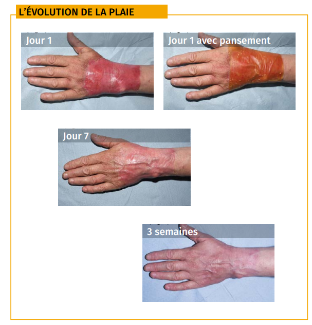 Evolution plaie etude de cas brulure et miel de manuka