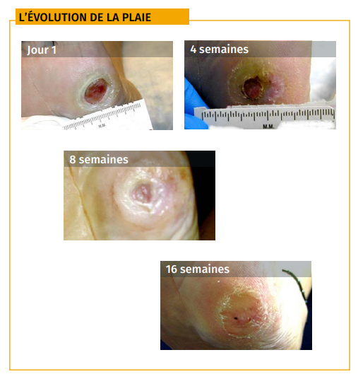 évolution plaie pied diabétique