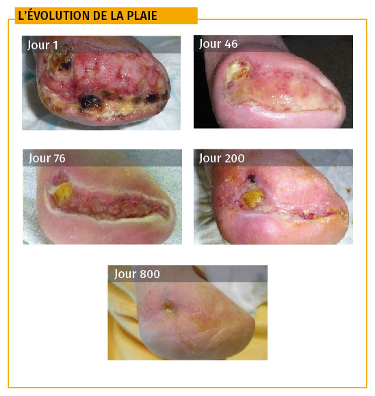 évolution plaie pied diabétique cas 2