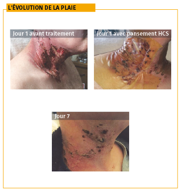 Evolution plaie radiations cou et bouche