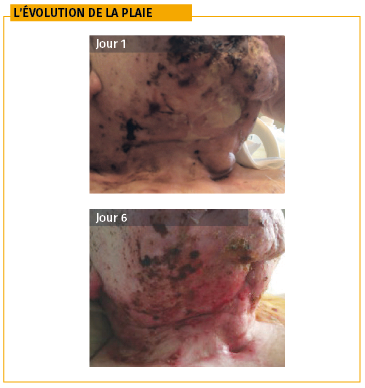 Evolution plaie radiations cou visage