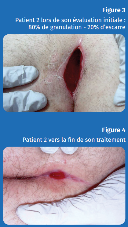 Figure 3 et 4 patient 2