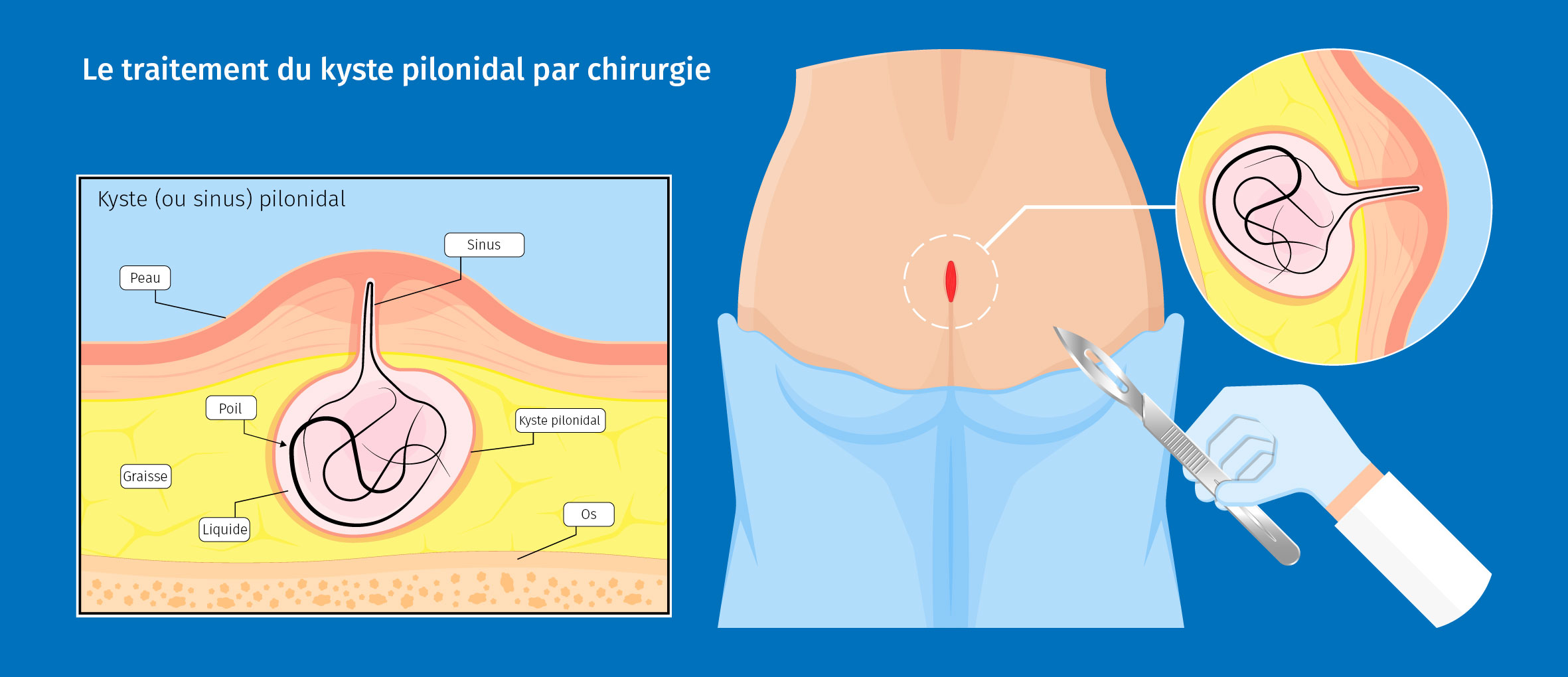 Kyste pilonidal traité par chirurgie