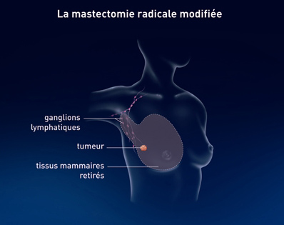 mastectomie-_radicale