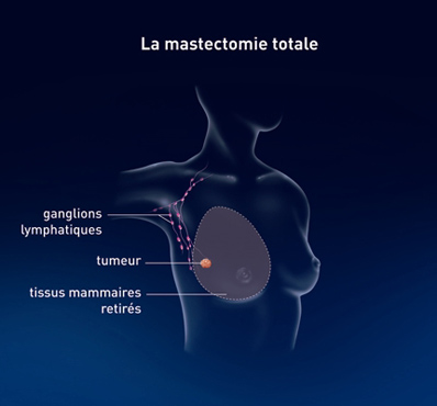 mastectomie-totale