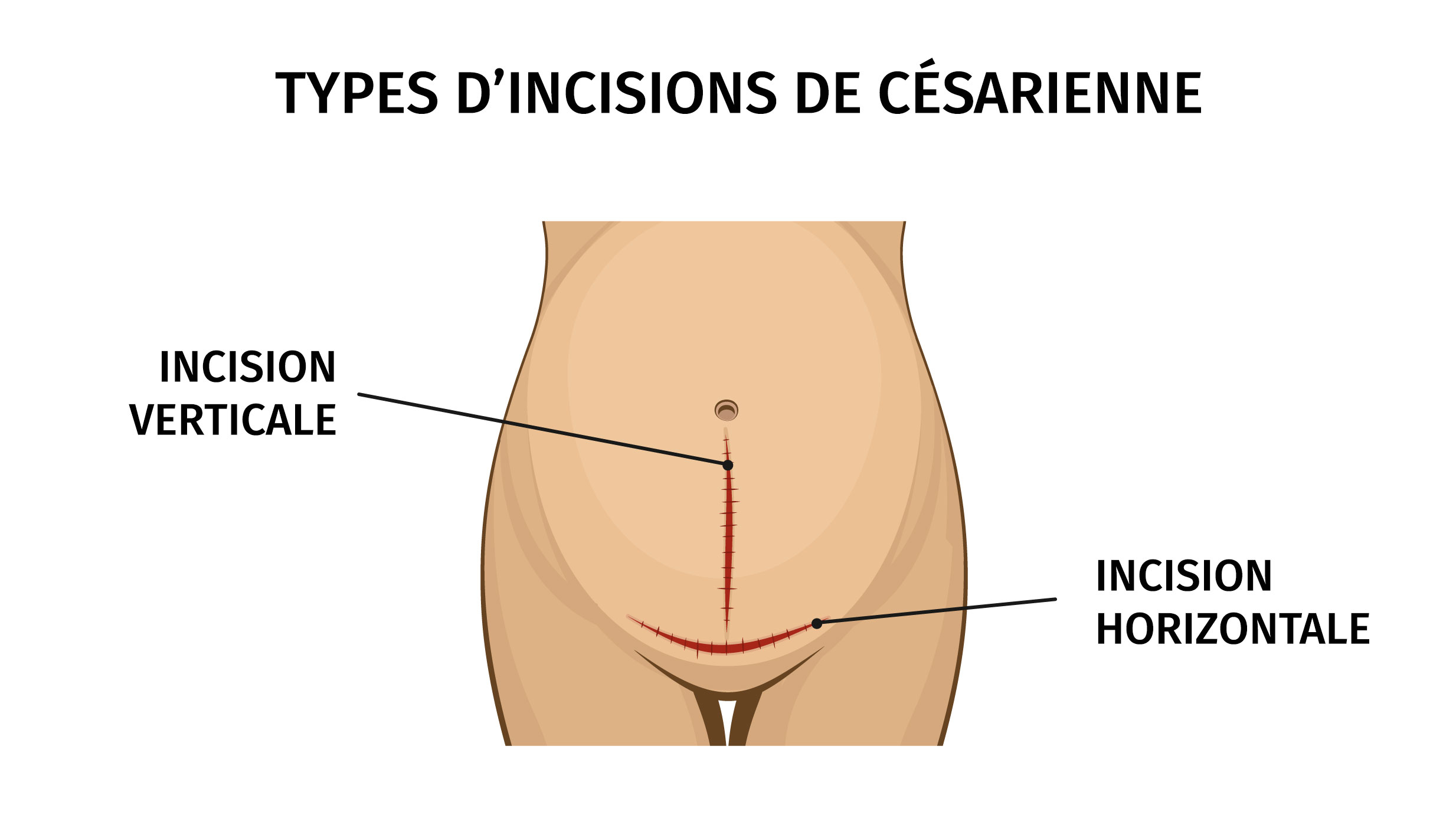 Patchs cicatrisants Césarienne - La Bambinerie d'Amela